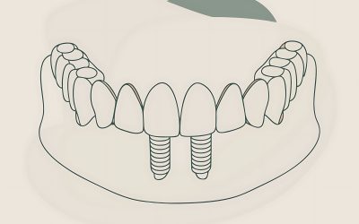 Zubni implantati